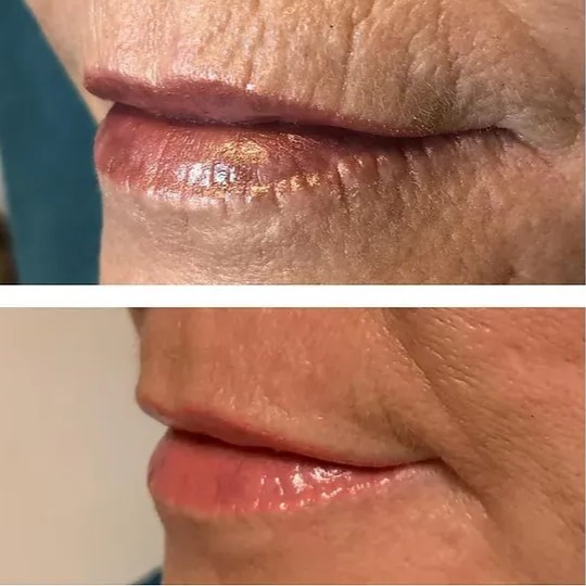 pre i posle PLEXR tretmana