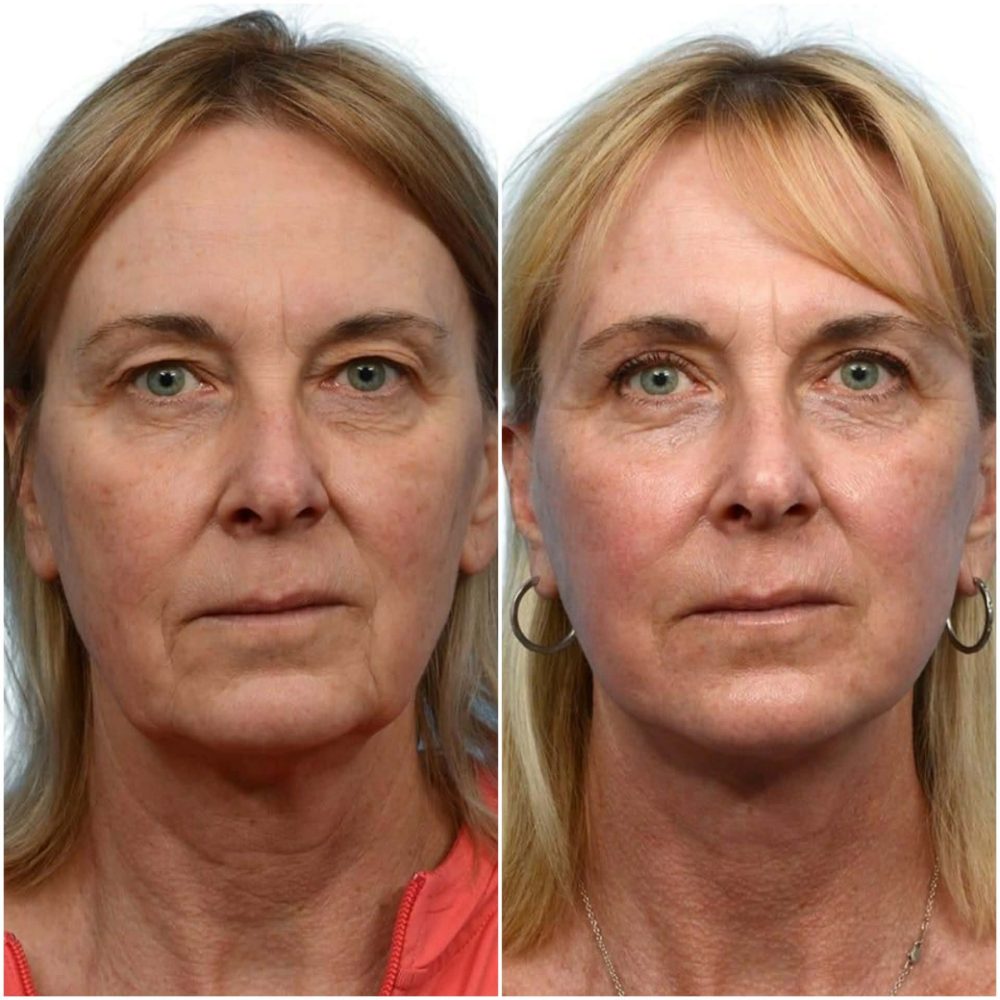 facelift